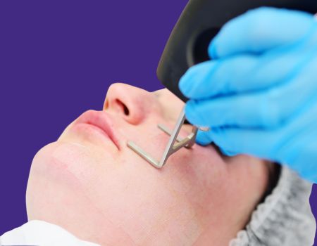 CO2 Laser - CO2 Fractional Laser Treatment Dubai, Abu Dhabi UAE | Kaya Skin Clinic